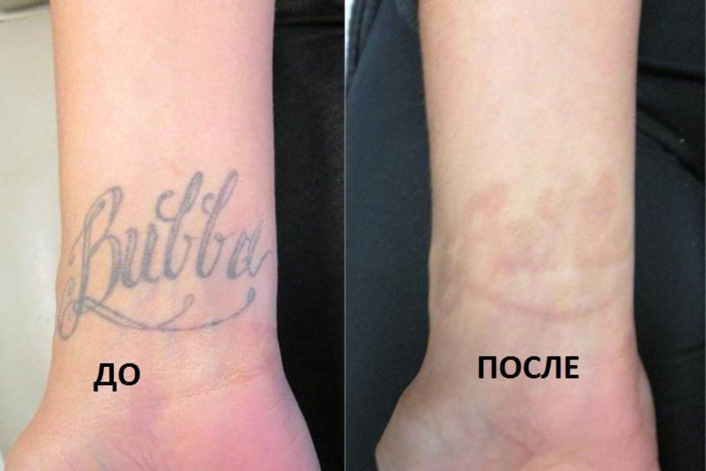 лазерное удаление татуировки лазерное удаление татуировки в косметологии Дворик Красоты в городе Реутов
