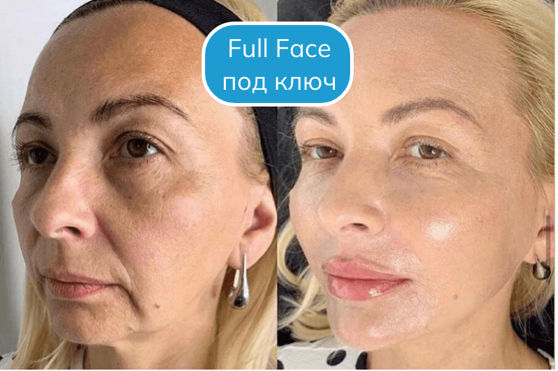 Лицо под ключ в Сочи Фулл фейс в Сочи
