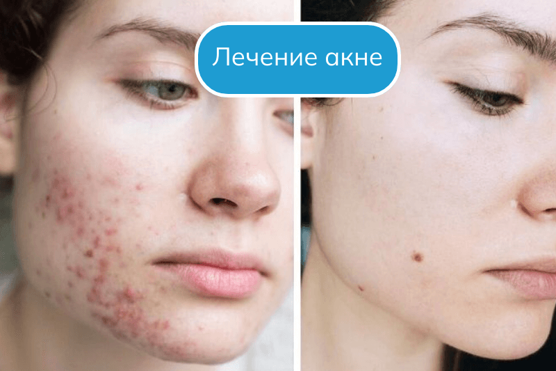 Лечение акне в Сочи Чистка лица в Сочи