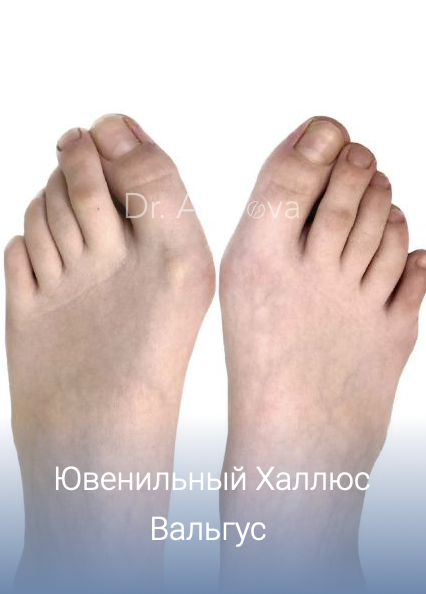 Халюс Вальгус у ребенка 4 года халюс Вальгус у детей: причины, симптомы, диагностика, лечение, профилактика, врач подолог хирург