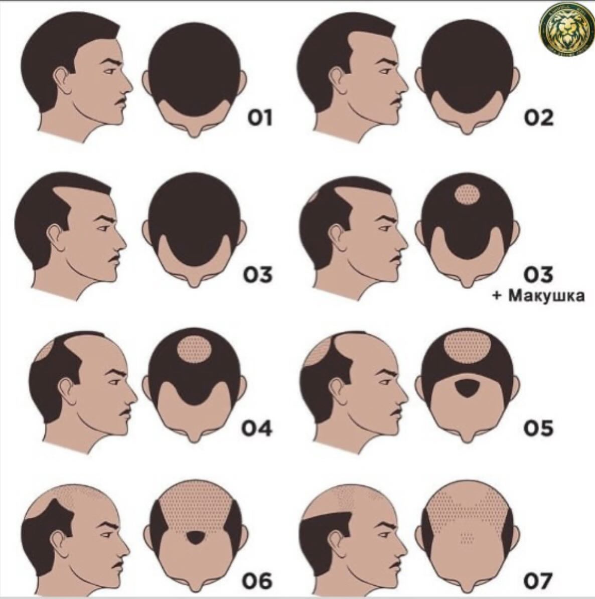 What FUE and DHI actually are