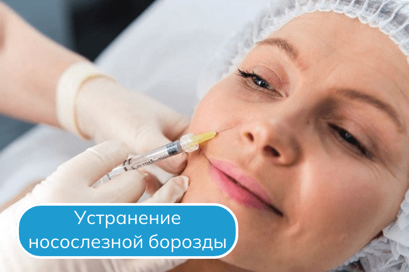 Носослезная борозда в Сочи Коррекция носослезной борозды в Сочи