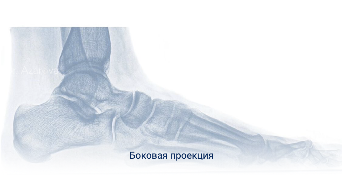 Рентген стоп рентген стоп сбоку