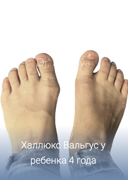 Халюс Вальгус у ребенка 4 года халюс Вальгус у детей: причины, симптомы, диагностика, лечение, профилактика, врач подолог хирург