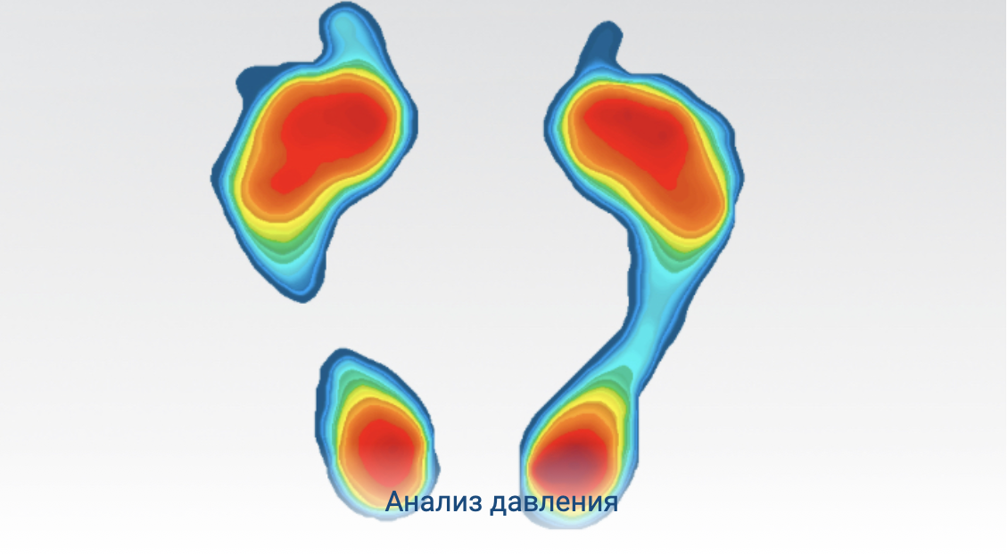 Анализ подошвенного давления анализ плантарного давления, отпечаток стопы