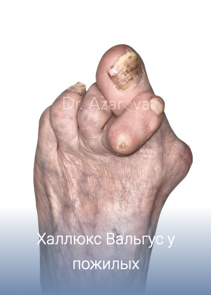 Халюс Вальгус халюс Вальгус у мужчин: причины, симптомы, диагностика, лечение, профилактика, врач подолог хирург
